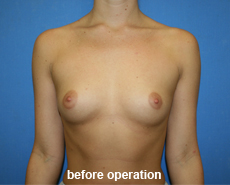 plastic-surgery-breast-augmentation